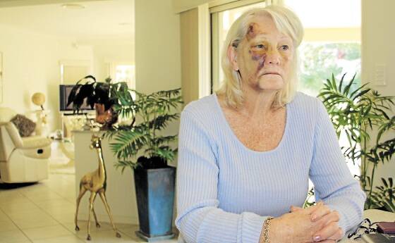 HURTING: Rosalind Ashton still has the bruises a week after her fall. Picture: Jessica Brown