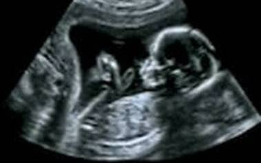 A supplied image of an ultrasound of a pregnant woman.