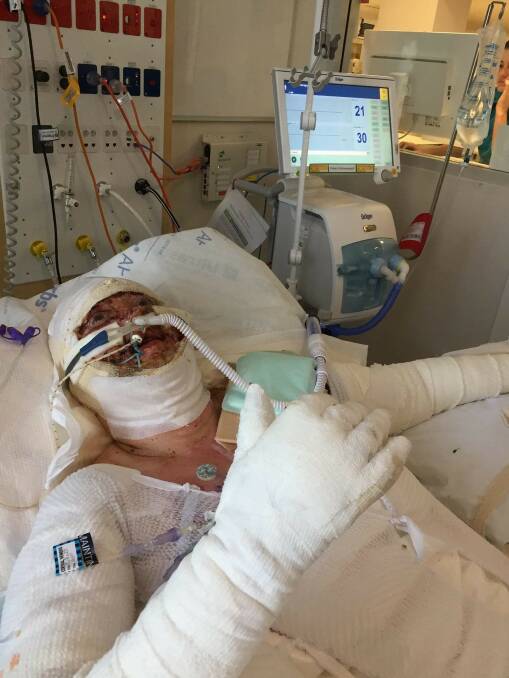 RECOVERING: Corlette mother-of-three Melina Heyward in the burns unit of the Royal North Shore Hospital.