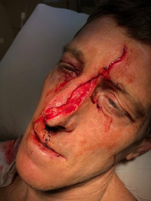 The surfboard fin cut to the bone and left a deep gash across Rod Morris's face. Picture: Supplied