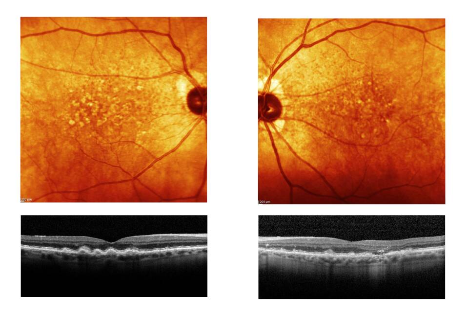 Drusen spots: These images show the yellow spots, known as drusen, which are indicators of macular degeneration. These symptoms may start to appear in people around 50-60 years of age, so it is best to have your eyes tested.