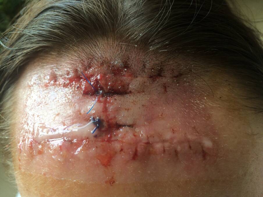 Close up: Alice Johnson's head wound.
