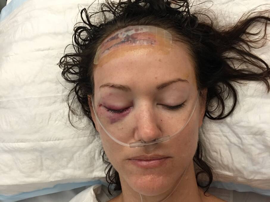 "I turned around and it hit me in the face. It took a big hole out of my head.”